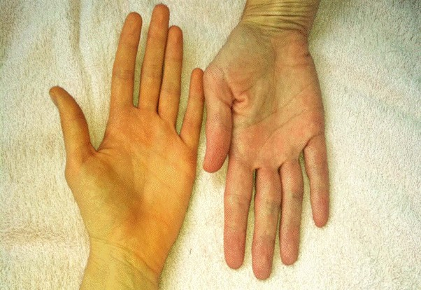 Gan Thải Độc Qua Da – Dấu Hiệu Nhận Biết Và Giải Pháp Hiệu Quả