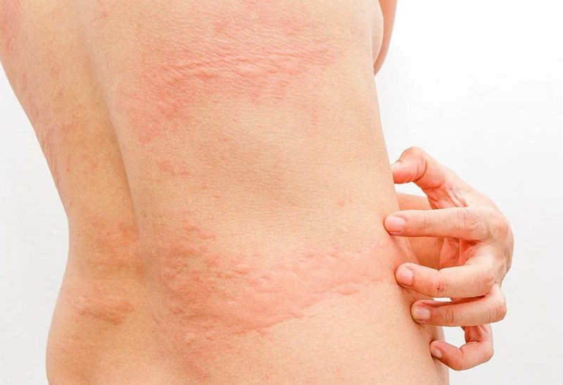 Gan Thải Độc Qua Da – Dấu Hiệu Nhận Biết Và Giải Pháp Hiệu Quả